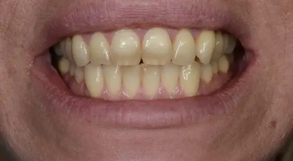 Denti ingialliti, forse a causa della clorexidina. La bocca è aperta, mostrando un sorriso.