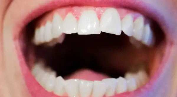 Bocca aperta con denti bianchi e ravvicinati, un esempio di affollamento dentale.