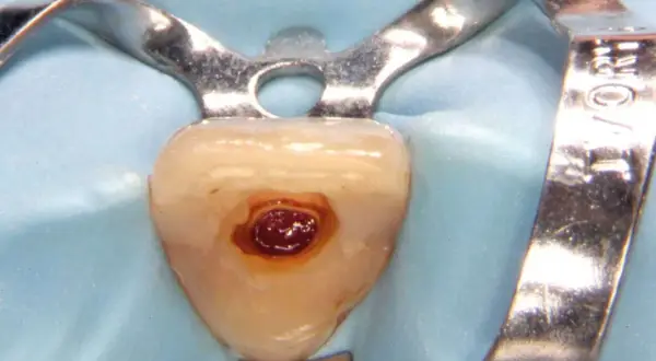 Dettaglio di un dente con cavità preparata per il cemento radicolare, isolato con diga di gomma e clamp metallico.