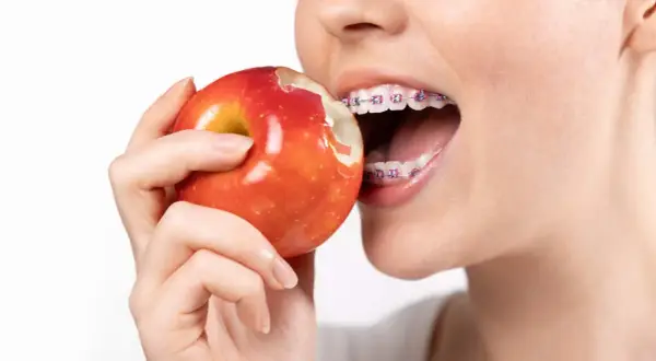 Mentre si morde una mela rossa, si vedono i denti con l'apparecchio. Un esempio di cosa mangiare con l'apparecchio, con cautela.