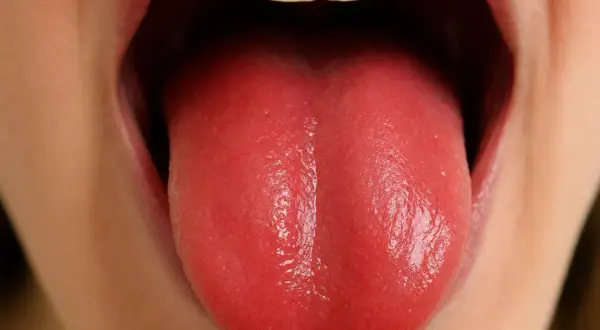 Lingua rossa e liscia, con papille gustative quasi assenti, segno di glossite atrofica.