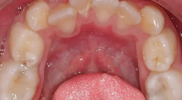 Vista ravvicinata dell'arcata dentale inferiore con evidente affollamento dentale inferiore. Si notano denti leggermente storti e sovrapposti.