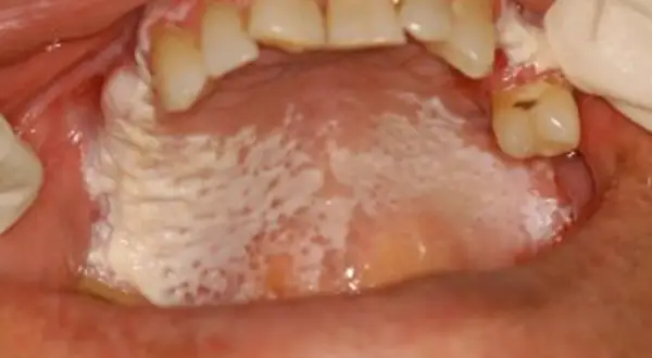 Leucoplachia palato: placche biancastre e irregolari sul palato, con aree rosse e puntini.