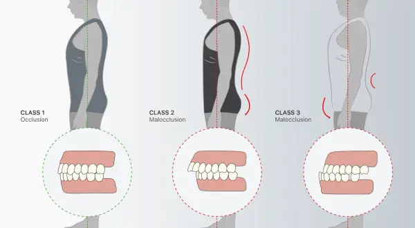 Illustrazione della classificazione di angle: Class 1 (occlusione corretta), Class 2 e Class 3 (malocclusioni) con dettagli dentali.