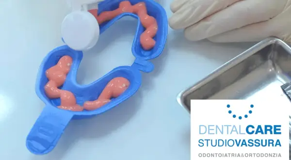 Applicazione di gel per fluoro profilassi in un portaimpronte dentale.