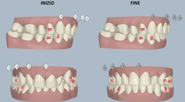 Confronto tra denti prima e dopo il trattamento ortodontico, con evidenziati gli attachment Invisalign.