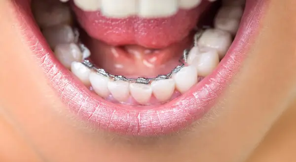 Primo piano di una bocca con apparecchio ortodontico. Un apparecchio per rieducare la lingua aiuta a correggere la posizione dei denti.