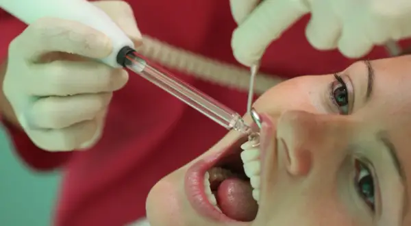 Trattamento dentale con ozono. Un dentista usa uno strumento per applicare il gel ozono sui denti di una paziente.
