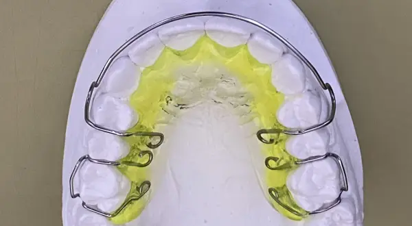 Modello di gesso con una placca di Hawley colorata di giallo, pronta per correggere l'allineamento dentale.