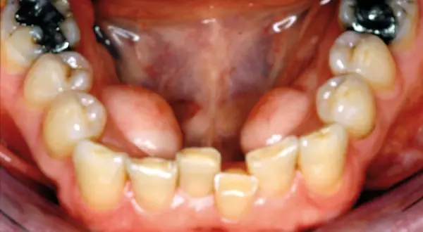 Vista ravvicinata della bocca con denti inferiori e superiori visibili. Si nota una piccola protuberanza carnosa, forse un'esostosi, sulla gengiva.