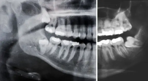 Radiografia panoramica mostra un dente incluso, probabilmente un molare, intrappolato nell'osso mascellare, impedendone la corretta eruzione.