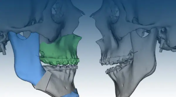 Modellazione 3D di un intervento maxillo-facciale per correggere una terza classe, evidenziando le aree di osteotomia e i potenziali rischi.