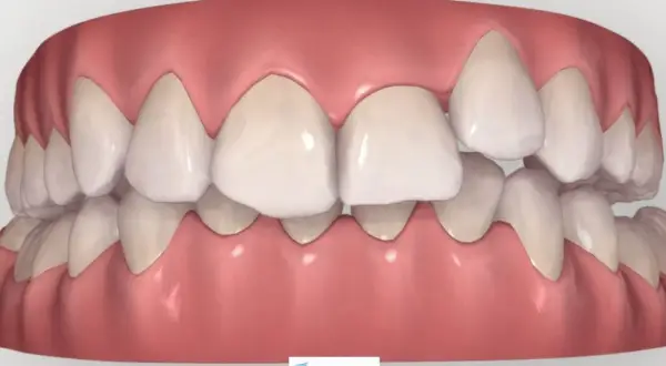 Arcata dentale con un dente storto in evidenza, che necessita di correzione ortodontica per un sorriso perfetto.
