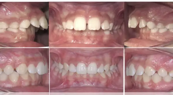 Denti sporgenti prima e dopo: vista laterale e frontale di un sorriso con denti allineati e corretti.