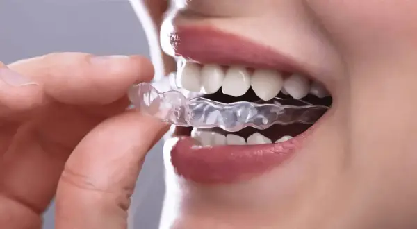 Dita inseriscono un bite dentale trasparente per rilassare la muscolatura.