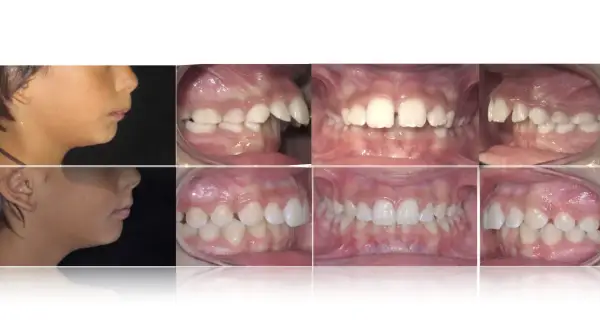 Prima e dopo: correzione di denti a castoro e malocclusioni.