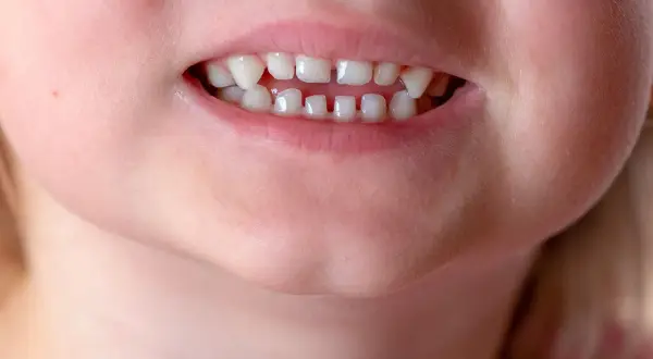 Primo piano di un sorriso di bambino con un diastema tra i denti inferiori, che mostra i denti da latte.