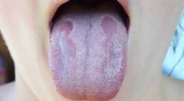 Lingua con placche biancastre, sintomo di candida orale. Si valuta l'uso di fermenti lattici per candida orale.