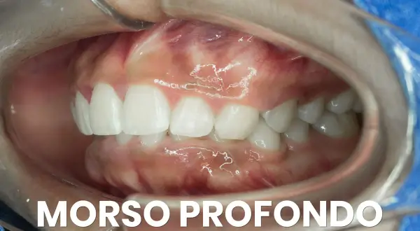 Denti bianchi e gengive rosa in un'apertura orale. Si nota un morso profondo, dove i denti superiori coprono quasi completamente quelli inferiori.