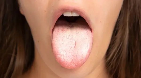 Lingua con patina biancastra e rossore, possibile sintomo di candida orale da stress.