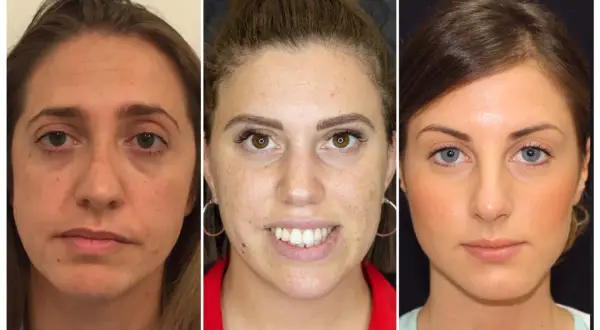 Tre volti di donna mostrano una grave asimmetria facciale prima e dopo un trattamento estetico.