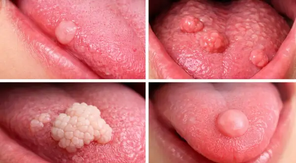 Varie protuberanze in fondo alla lingua, alcune singole e arrotondate, altre più grandi e a grappolo, mostrano diverse condizioni della lingua.
