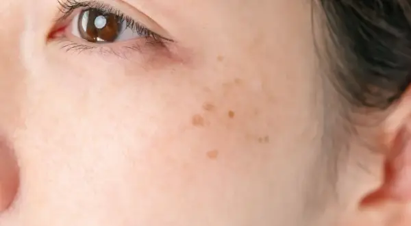 Primo piano del volto di una donna con una piccola macchia scura interno guancia, vicino all'occhio.