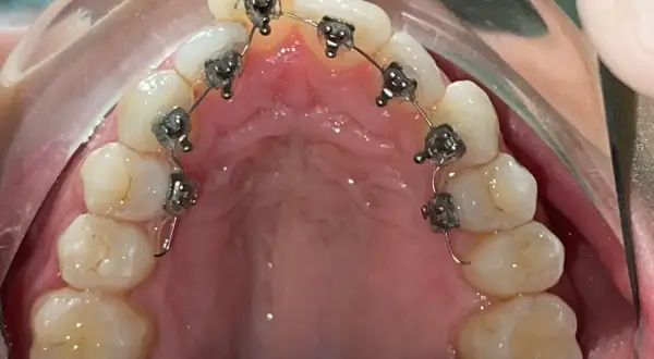 Dettaglio di un apparecchio linguale applicato ai denti superiori, quasi invisibile dall'esterno.