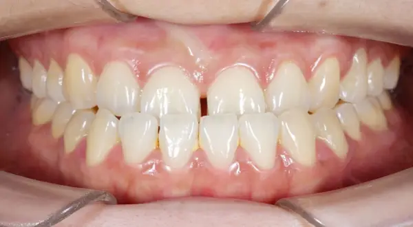 Denti superiori e inferiori di un adulto con un evidente morso incrociato. Si nota uno spazio tra gli incisivi superiori.
