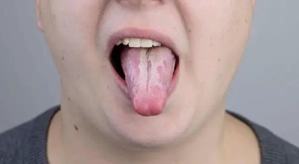 Lingua strana dopo antibiotico, con patina bianca e striature rosate.
