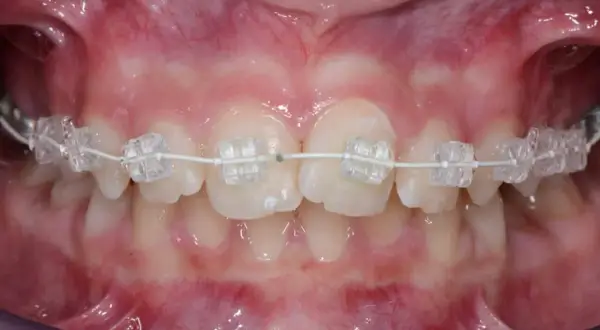 Primo piano di denti con apparecchio trasparente. Il filo bianco collega i bracket, mostrando il progresso del trattamento ortodontico e suggerendo ogni quanto si cambia il filo dell'apparecchio.