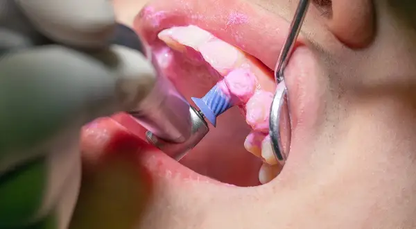 Dettaglio di una pulizia denti professionale con pasta lucidante rosa e uno strumento rotante.
