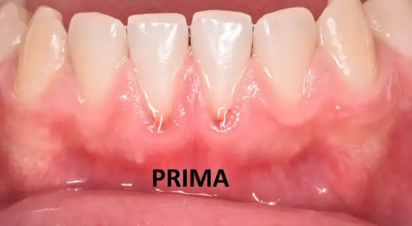Gengive arrossate e gonfie, con segni di infiammazione, suggeriscono una stomatite gengivale. La parola "PRIMA" indica la situazione iniziale.