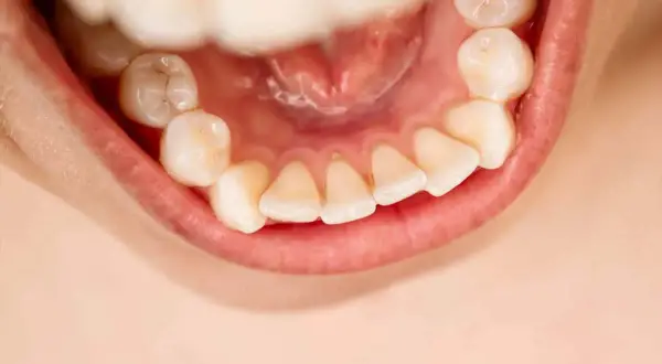 Denti ingialliti e con accumuli di tartaro, un rischio che fa cadere i denti.
