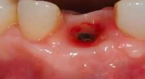 Cavità gengivale infiammata, forse un'alveolite, che mostra segni di guarigione.