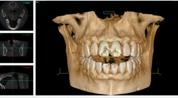 Vista 3D di denti con evidenziate aree di interesse. Si nota il canale naso palatino nelle sezioni assiale e coronale.