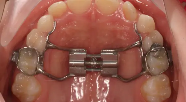 Espansore palatino con bite block ortodonzia. Strumento metallico per allargare il palato, fissato ai denti.
