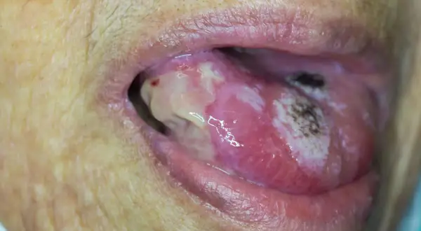 Lingua con lesioni biancastre e aree necrotiche, suggestive di carcinoma squamoso lingua.