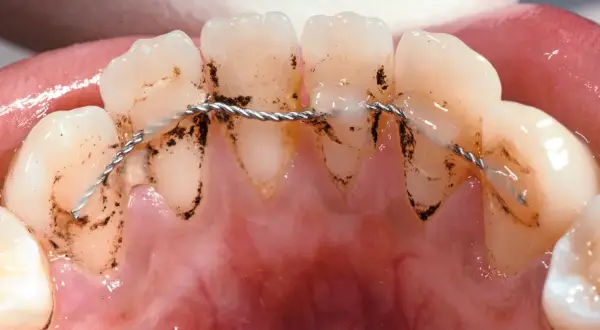 Denti con accumuli di placca e tartaro attorno a un retainer fisso.