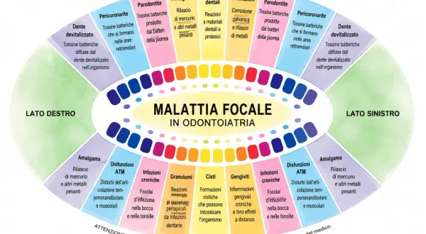 Schema sulla malattia focale in odontoiatria: denti devitalizzati, parodontite, amalgama e altri problemi legati ai **quadranti denti**.