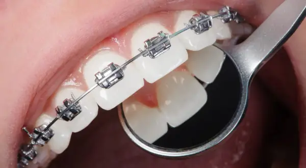 Dettaglio di denti con apparecchio ortodontico metallico. Un piccolo specchietto riflette i denti, mostrando come si mette l'apparecchio.