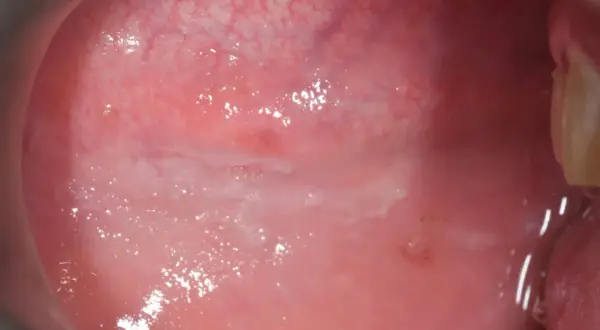 Guancia interna con area biancastra e lievemente rialzata, sospetto fibroma.