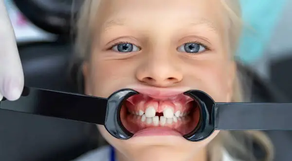 Bambina con diastema, uno spazio tra i denti. Non tentare di chiudere lo spazio tra i denti fai da te, consulta un dentista.