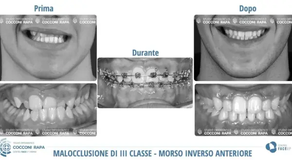 Prima e dopo un trattamento ortodontico per correggere una malocclusione dentale e problemi neurologici correlati.