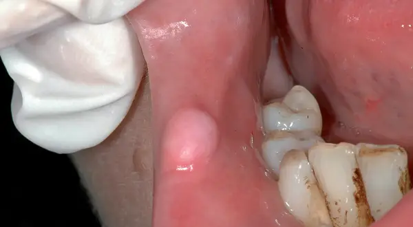 Guancia interna con gonfiore, forse dovuto a un morso. Denti visibili.