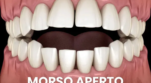 Denti con morso aperto. Si può mettere l'apparecchio anche avendo degli impianti dentali per correggere questa malocclusione.