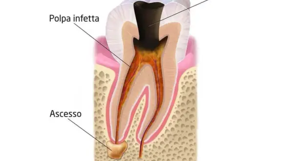 Dente infetto con carie e polpa infetta. Si nota un ascesso alla radice, segno di un'infezione avanzata.
