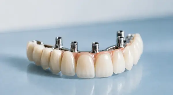 Protesi dentale fissa con denti staccati, fissata su pilastri metallici.