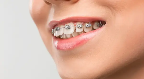Sorriso con apparecchio ortodontico per correggere una malocclusione mandibolare. Denti allineati e labbra lucide.
