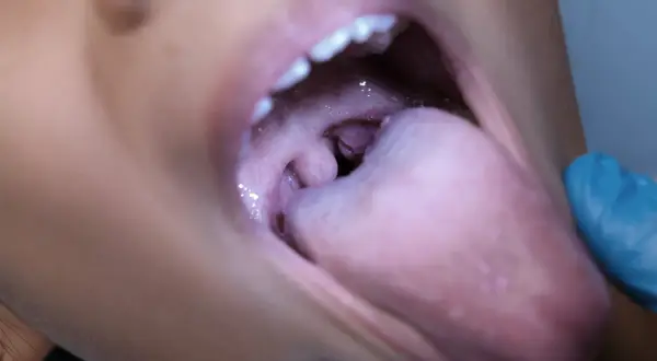 Bocca aperta con lingua e tonsille visibili. Se hai un palato gonfio, rimedi naturali possono aiutare.